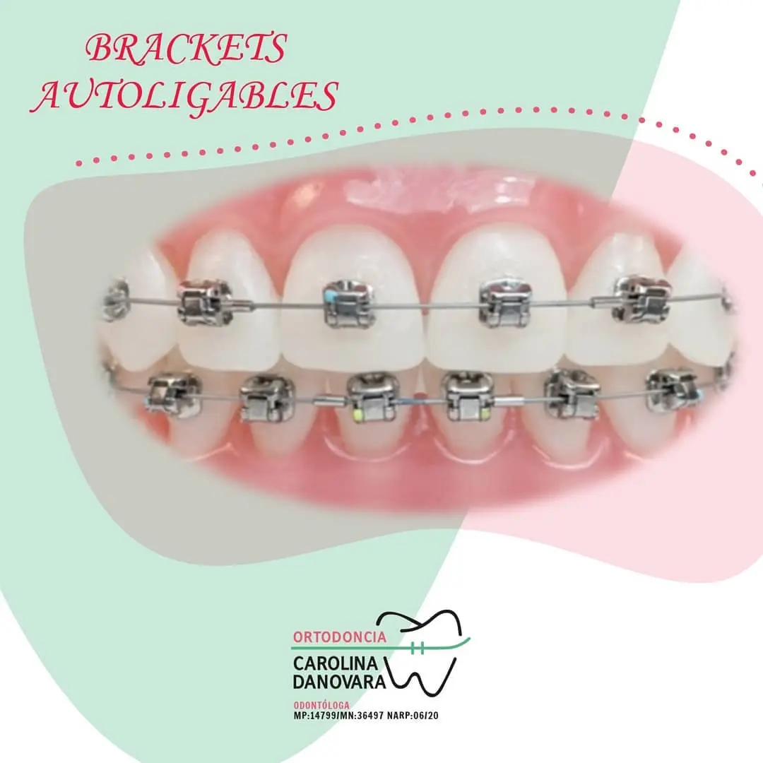 Brackets Autoligantes