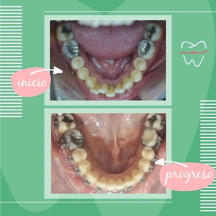 Caso antes y después con brackets - Adulto