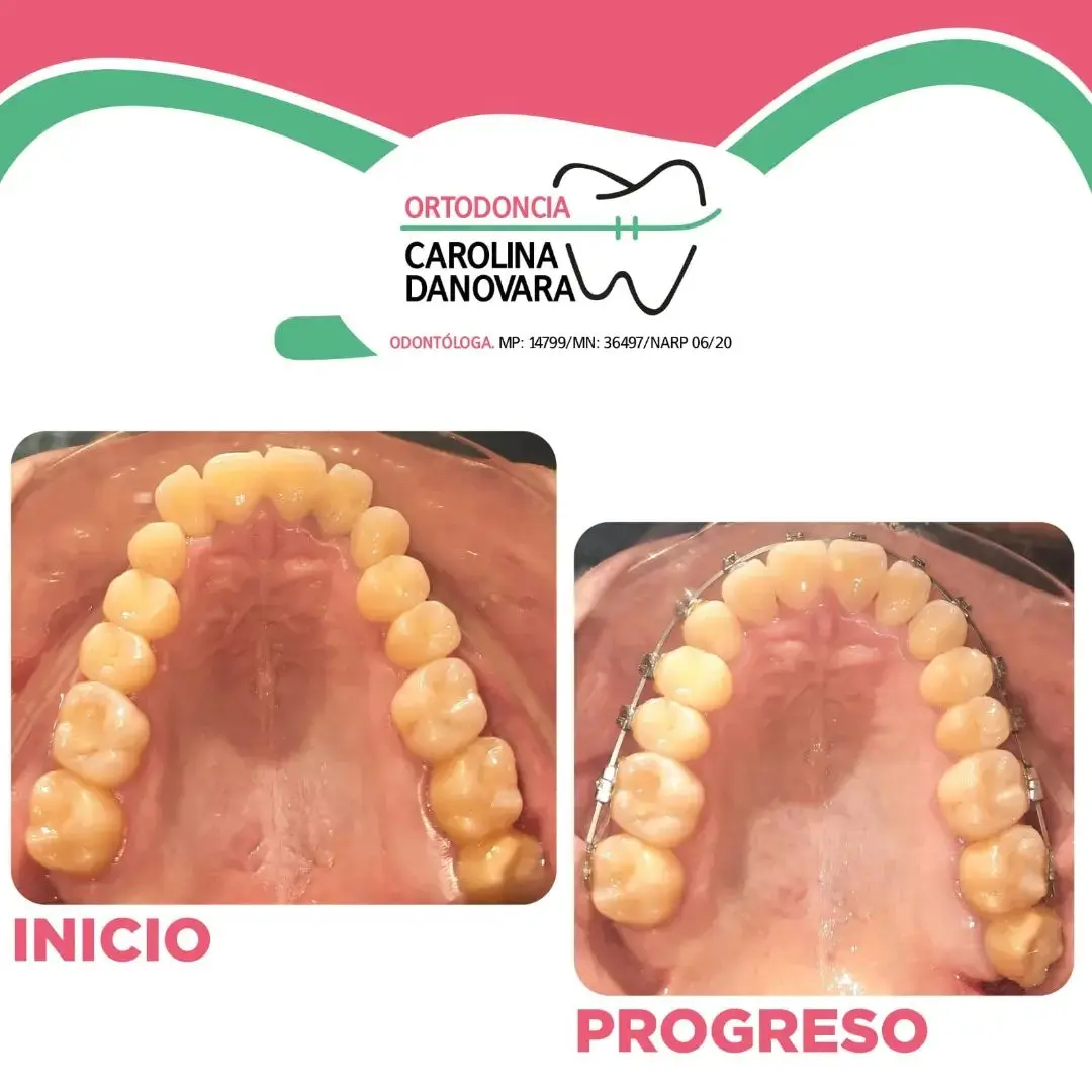 Caso antes y después con brackets - Niño