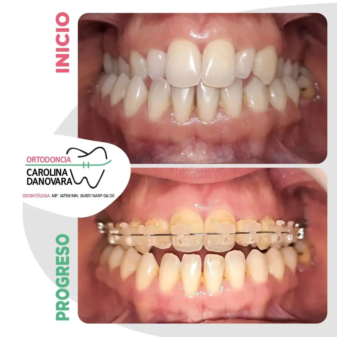 Caso antes y después con brackets - Adulto