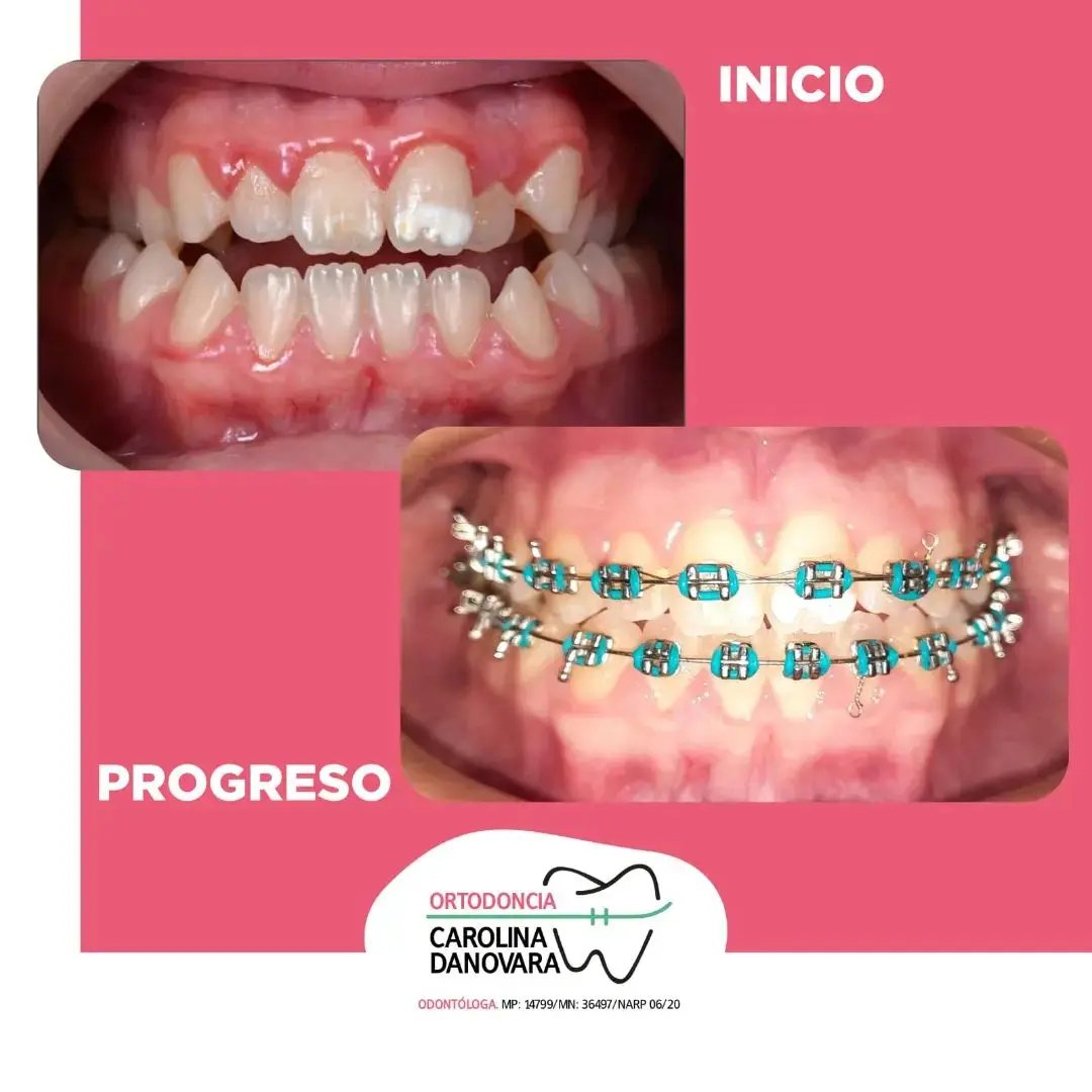 Caso antes y después con brackets - ninos