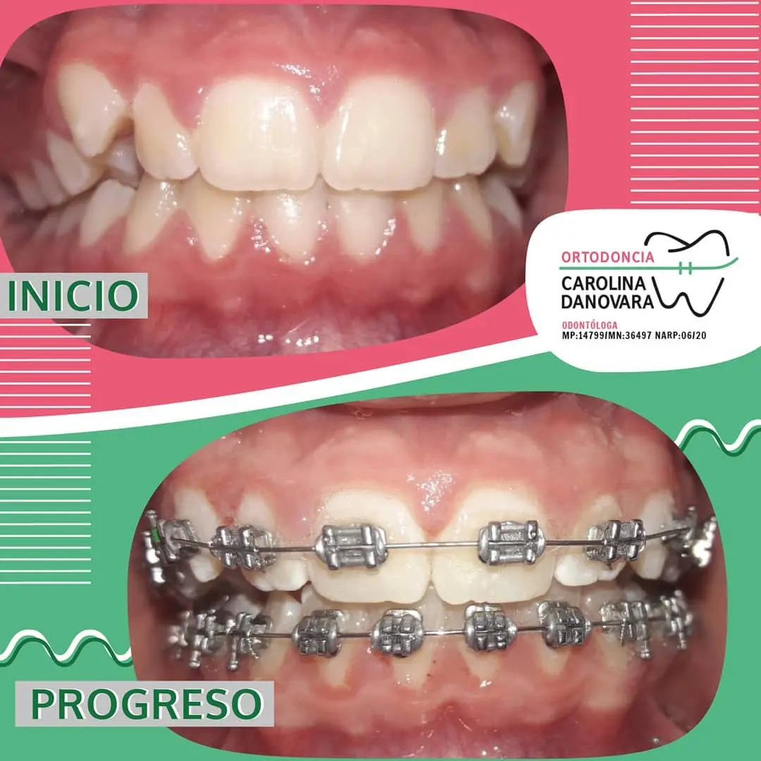 Caso antes y después con brackets - Niño